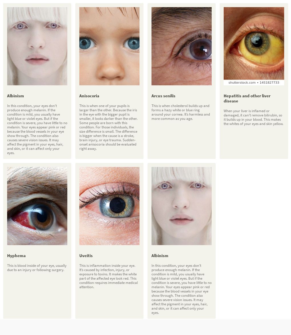 Coloboma: The Unusual Pupil - All About Eyes