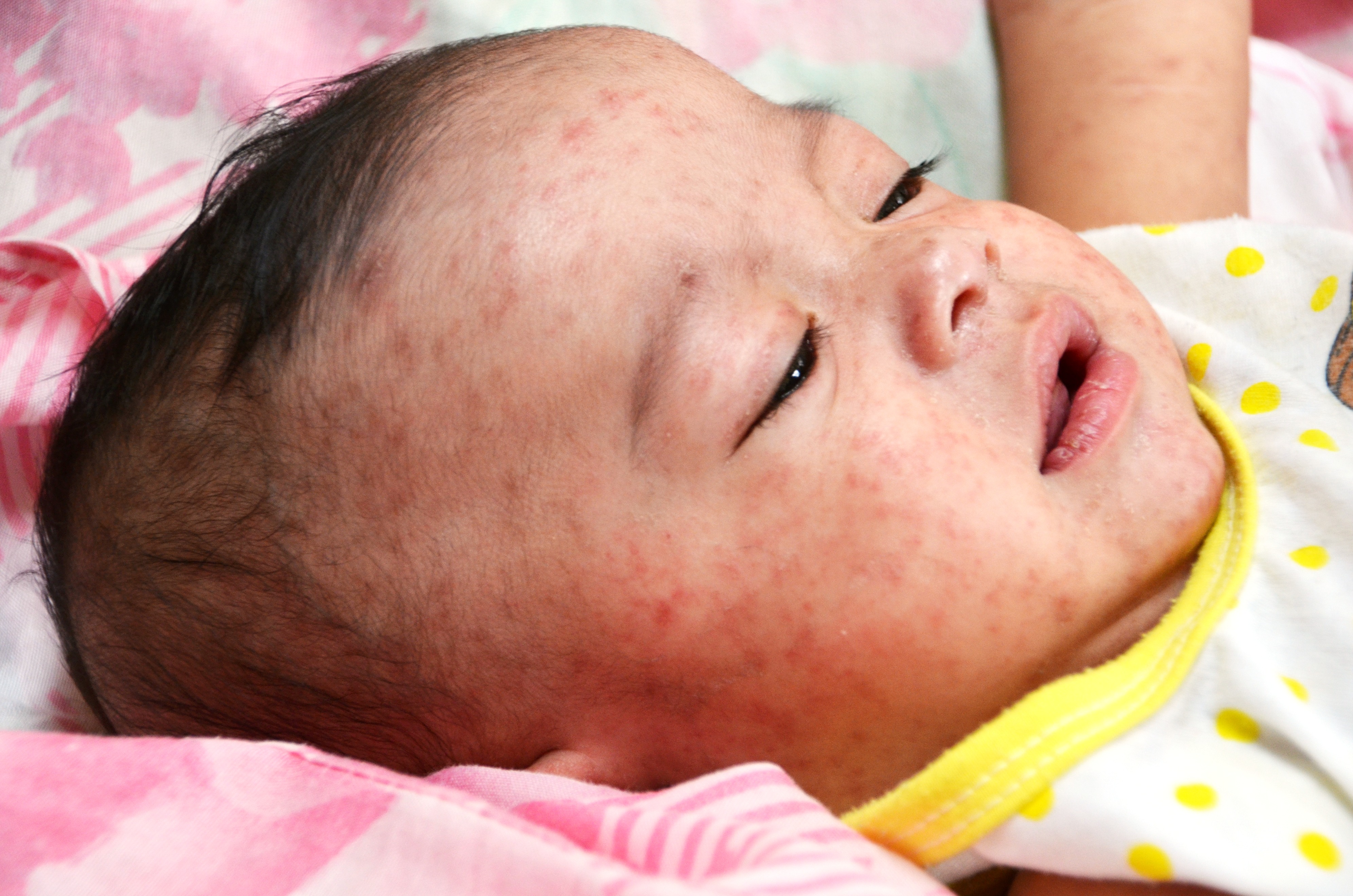 Measles: the vaccination rate slump fuelling an outbreak - The